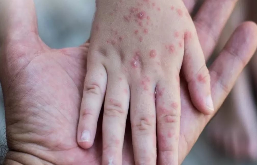 Kasus Campak di Sumsel Tembus 1.000 Suspek, Dinkes Gencarkan Imunisasi Anak