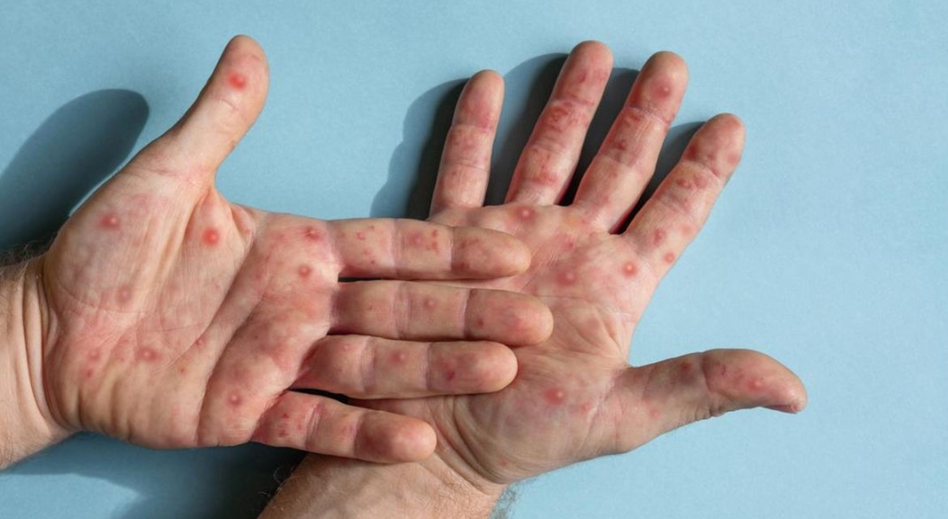 Pemerintah Tingkatkan Pengawasan Campak, Imunisasi Diperluas di Sejumlah Daerah