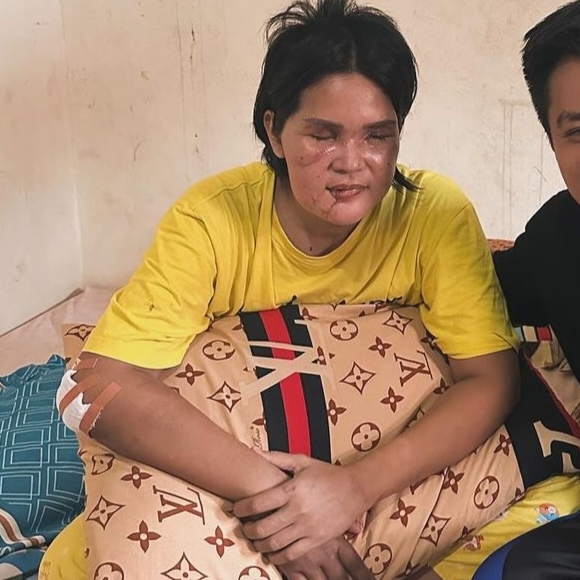 Korban KDRT di Bangka Belitung Sampai Kehilangan Kedua Matanya