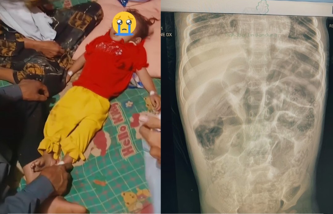 Raya Balita Sukabumi Meninggal, RS Jelaskan Infeksi Cacing Parah yang Dialaminya