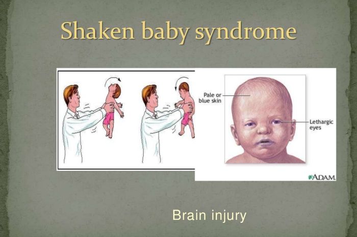 Bayi Mengalami Sindrom Terguncang, Ini yang Harus Diketahui?