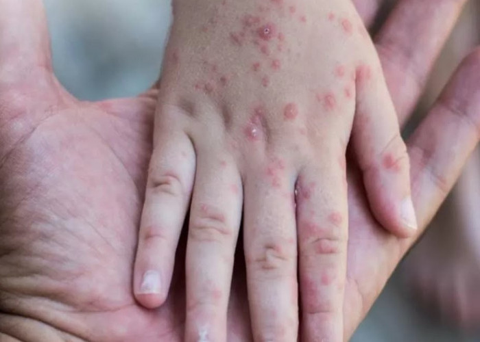 Kasus Campak di Sumsel Tembus 1.000 Suspek, Dinkes Gencarkan Imunisasi Anak