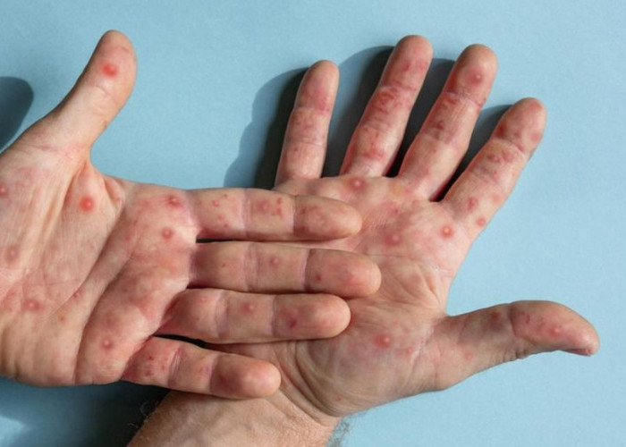 Pemerintah Tingkatkan Pengawasan Campak, Imunisasi Diperluas di Sejumlah Daerah