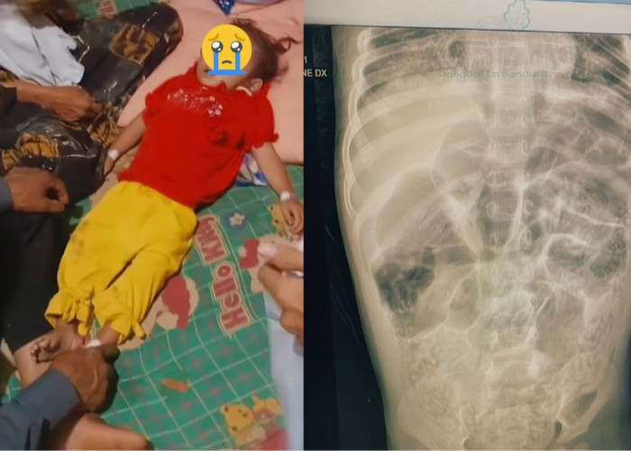 Raya Balita Sukabumi Meninggal, RS Jelaskan Infeksi Cacing Parah yang Dialaminya