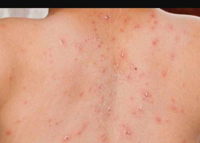 Warga Australia Terinfeksi Measles Usai Berkunjung ke Indonesia, Pemerintah Perkuat Surveilans dan Imunisasi