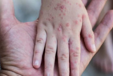 Kasus Campak di Sumsel Tembus 1.000 Suspek, Dinkes Gencarkan Imunisasi Anak