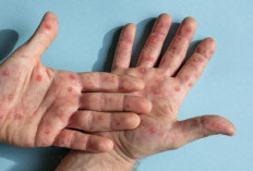 Pemerintah Tingkatkan Pengawasan Campak, Imunisasi Diperluas di Sejumlah Daerah