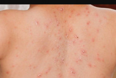 Warga Australia Terinfeksi Measles Usai Berkunjung ke Indonesia, Pemerintah Perkuat Surveilans dan Imunisasi